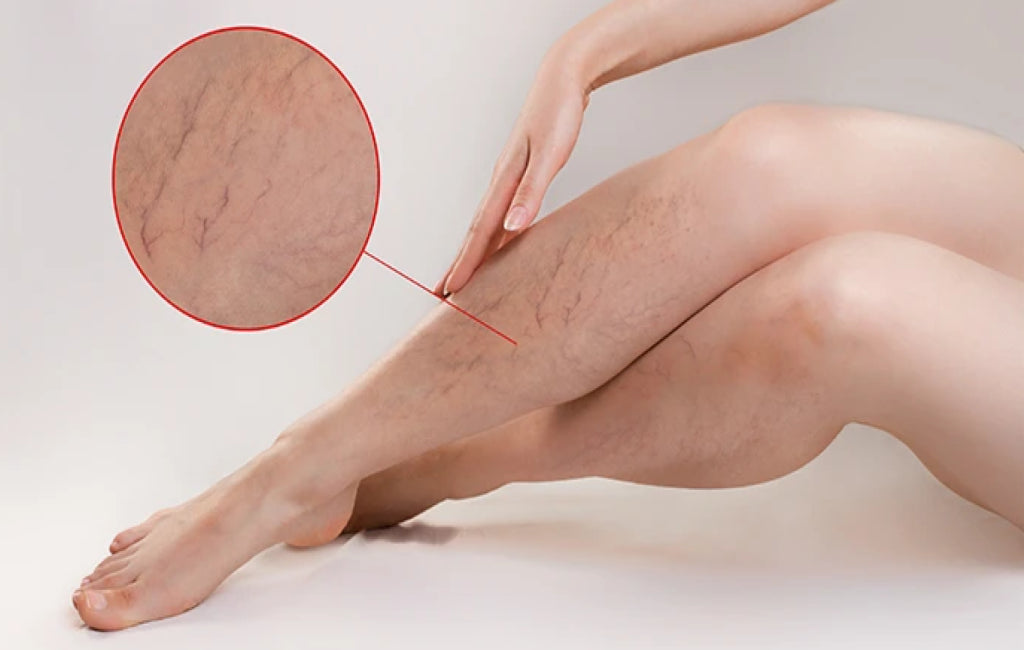 Cremă varice Sumifun TM