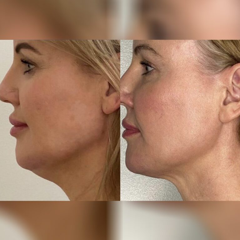 Drenaj limfatic BRUSH TM