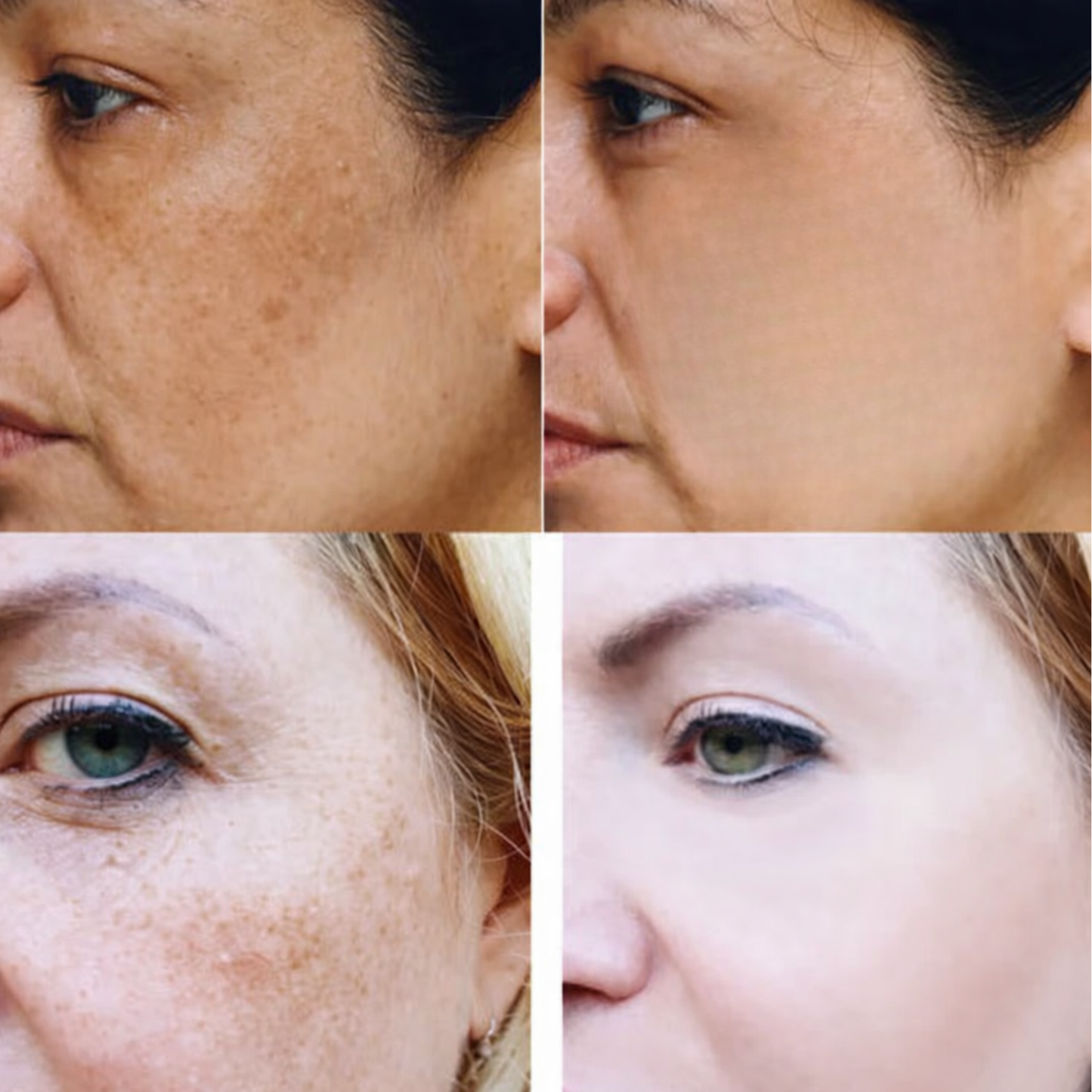 Cremă Corectoare pentru Pete Pigmentare, Pistrui și Cicatrici acneice