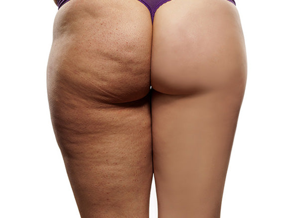 Netezește vergeturile. Conturează abdomenul.